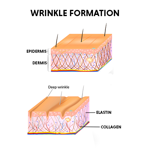 wrinkles treatment