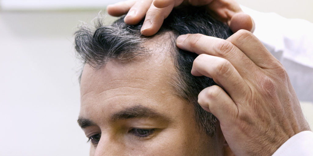 Syphilis Hair Loss - Know Its Causes And Treatments