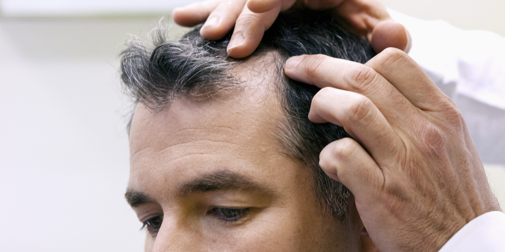 17 Best Hair Loss Treatments for Men in 2023