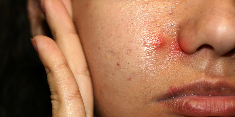 Acne Keloidalis Nuchae Akn Causes Symptoms Treatments And Tips