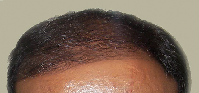 Before and after results of hair treatment