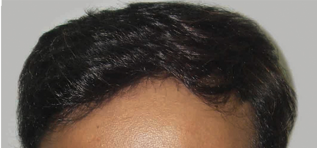 Before and after results of hair treatment