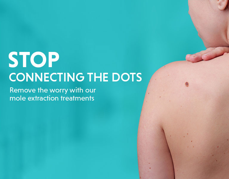 Mole Removal In Bangalore - Laser Treatment For Moles In Bangalore Mole Removal In Bangalore - Laser Treatment For Moles In Bangalore