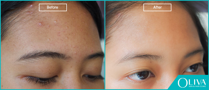 forehead acne before after