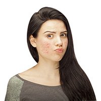 pimple/acne treatment