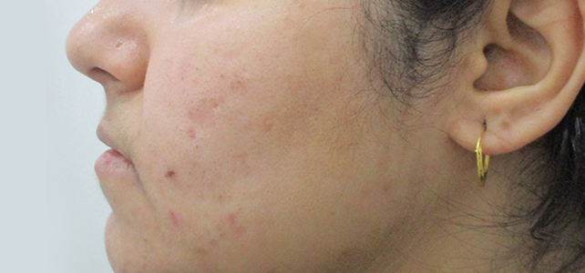 Before and after results of pimple treatment
