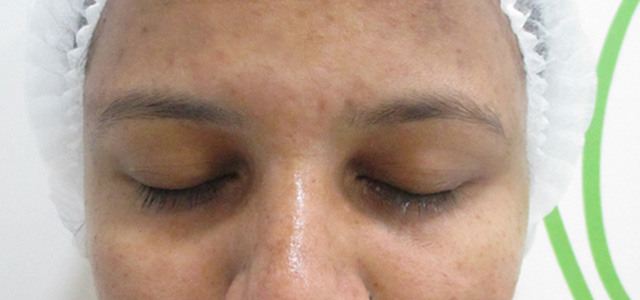 Skin pigmentation treatment After - Radhika @olivaclinic