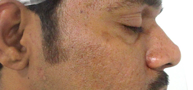 Before and after results of acne scar treatment