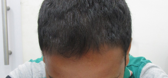 Before and after results of hair treatment
