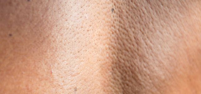 Skin moles treatment After - Sumitra @olivaclinic