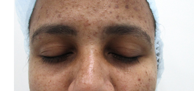 Skin pigmentation treatment Before - Radhika @olivaclinic