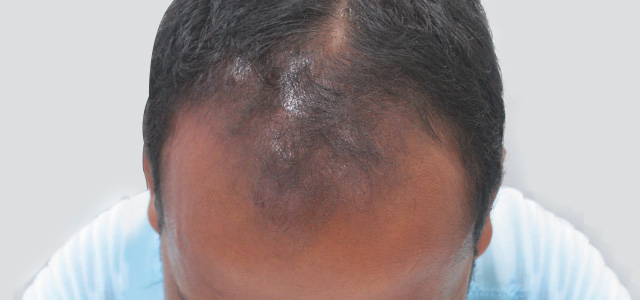 Hair loss treatment Before - Anvesh @olivaclinic