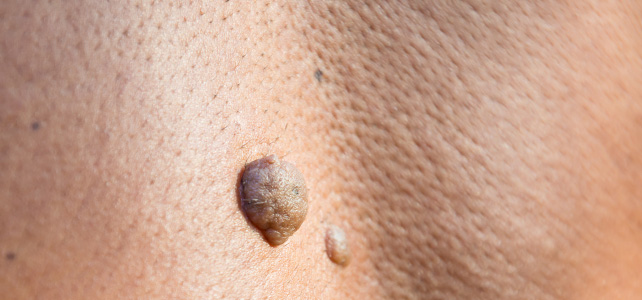 Skin moles treatment Before - Sumitra @olivaclinic