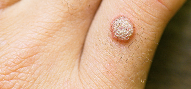 Warts removal treatment Before - Kavitha @olivaclinic