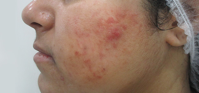 Before and after results of pimple treatment