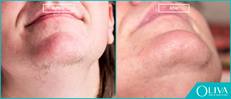 How To Remove Unwanted Hair From Upper Lip & Chin?