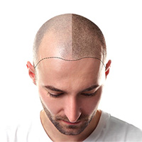 hair transplantation