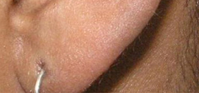 Before and after results of laser upper lip hair removal