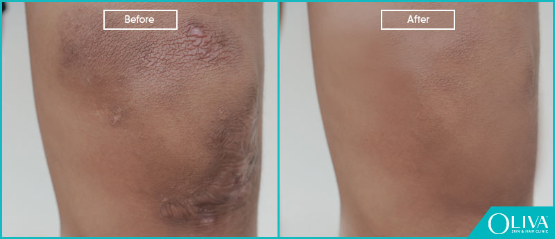 Scar post Bio Alcamide filler used on the leg (a) before (b) after