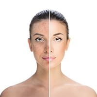 pigmentation treatment