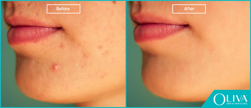 zits before and after