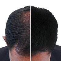 prp treatment for hair fall and hair loss