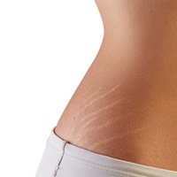 stretch marks removal treatment