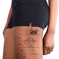 Laser Tattoo Removal Clinics - Get Rid Of Professional/ Homemade Tattoos