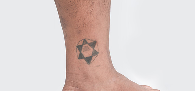 Laser tattoo removal Before - Vikram @olivaclinic