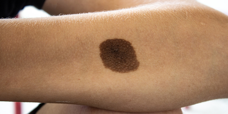 Melanocytic Nevus