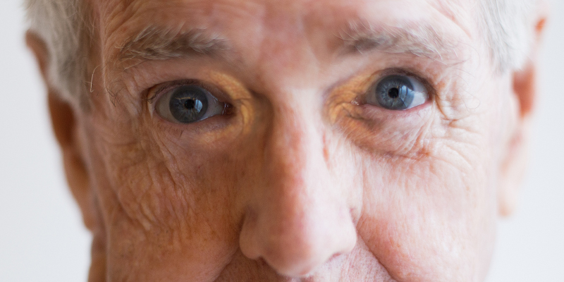 Xanthelasma Palpebrarum Pictures