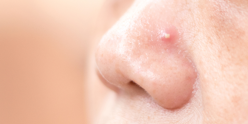 How To Get Rid Of Zits And Zit Scars