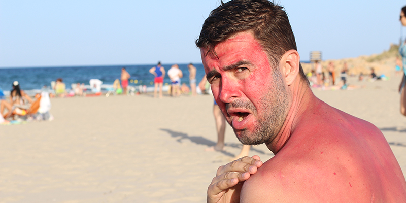 Sunburn: Symptoms & Treatment