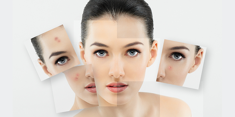 Pimple And Acne Scar Removal Treatment In Kochi