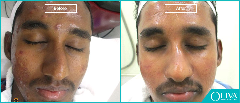 acne treatment before and after