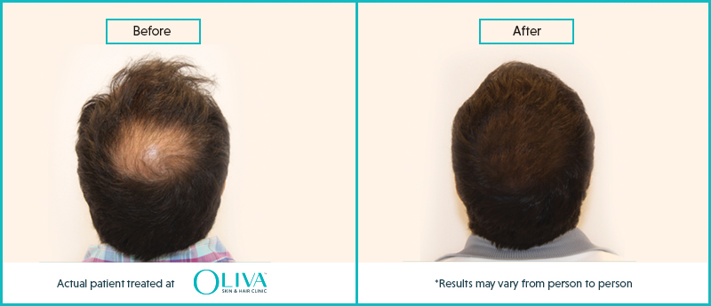 prp hair fall treatment in kolkata