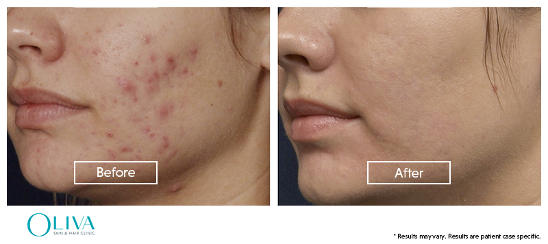 before and after pimple acne scar 