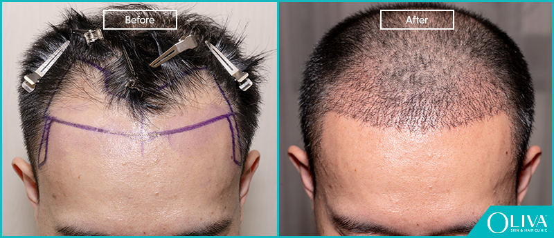 What Is Hair Transplant And Is Hair Transplant Permanent?