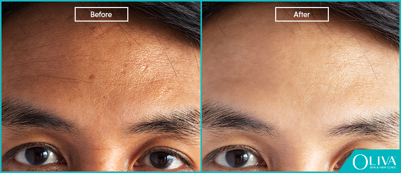 Skin Whitening before and after results