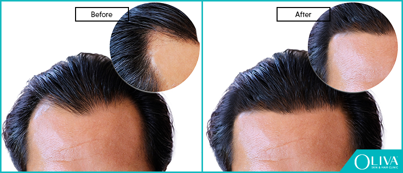 Best Hair Loss Treatment For Receding Hairline : Receding Hairline How.