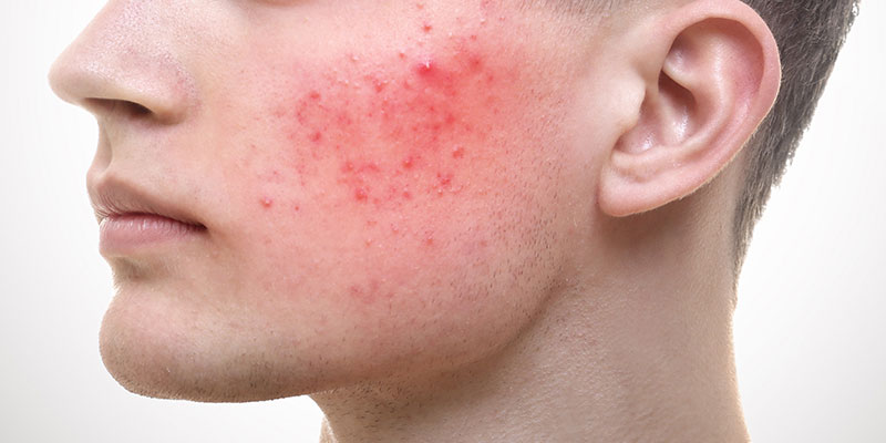 Acne Rosacea: Causes, Symptoms And Treatments In India