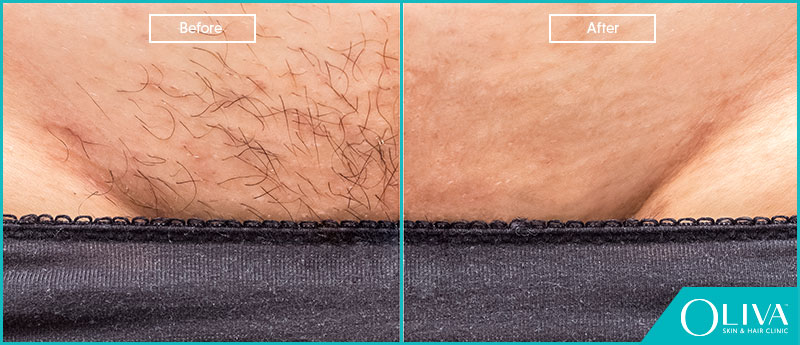 Does Laser Hair Removal Hurt Tolerating the Procedure