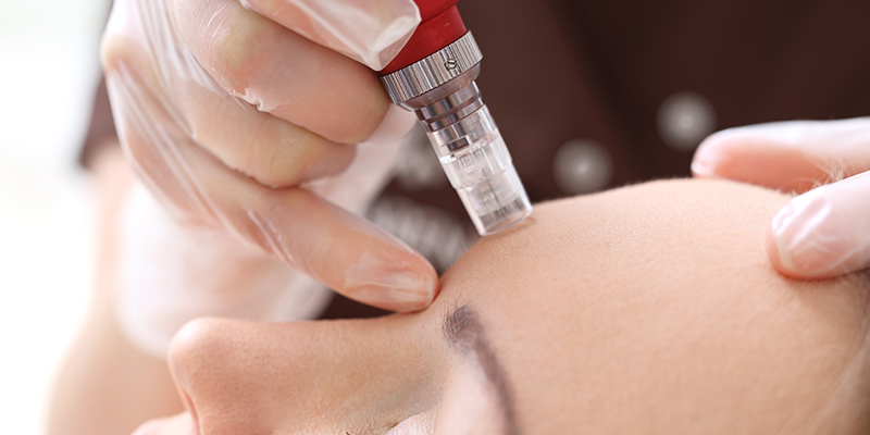 MNRF Treatment: Cost, Results, Benefits & Side Effects