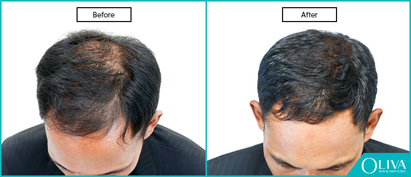 Male Pattern Baldness: Causes, Symptoms And Treatments