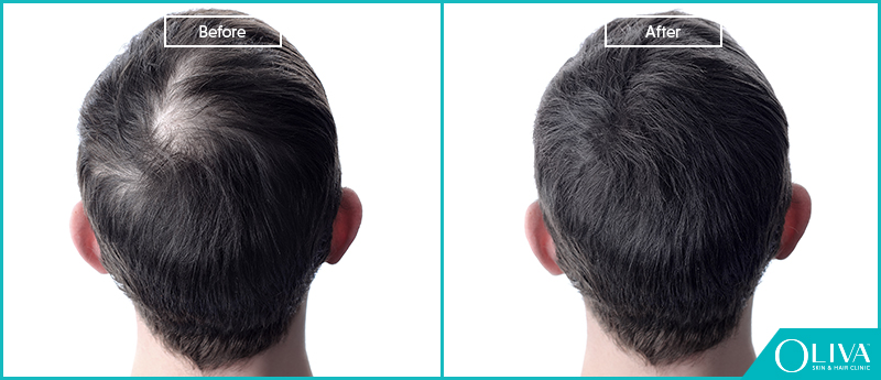 Treatment of Hair Loss in the Trichorhinophalangeal Syndrome