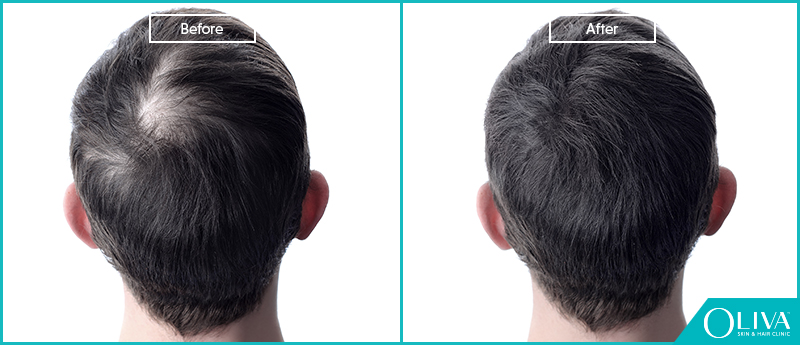 What to do about thin hairbalding at 15  rmalegrooming