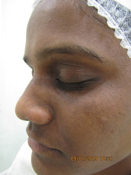 Skin lightening treatment After - Abhigan @olivaclinic