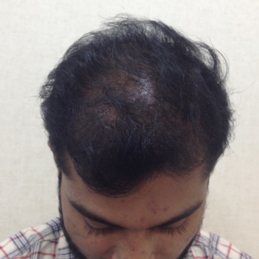 Hair loss treatment After - Abhishek @olivaclinic