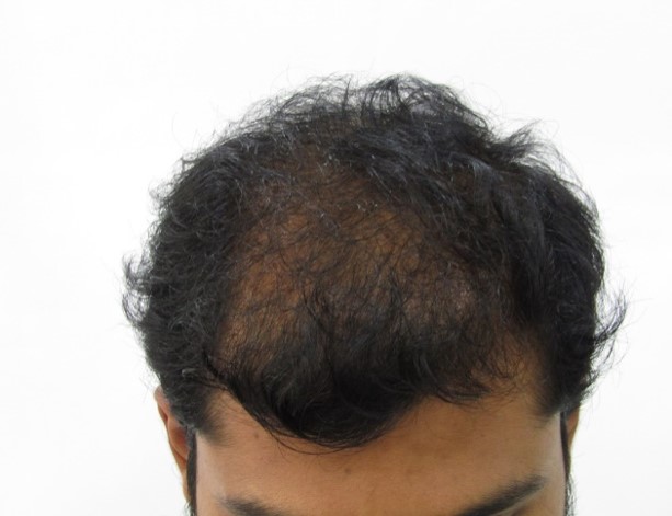 Hair loss treatment Before - Abhishek @olivaclinic