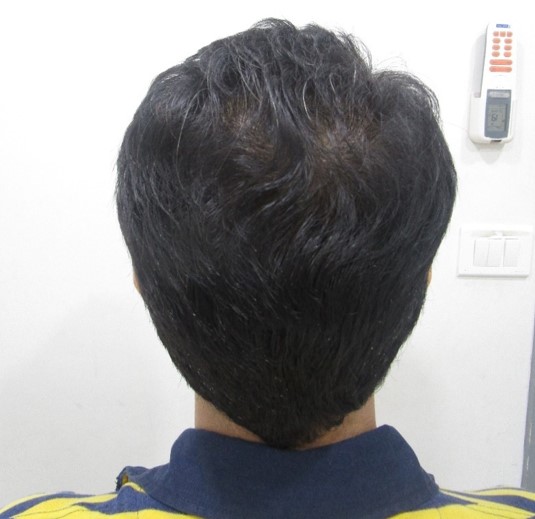 Hair loss treatment After - Aditya @olivaclinic